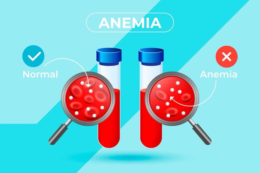 Anemia — skąd się bierze? Co to za przypadłość?